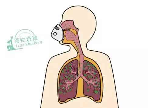 解开迷雾:雾化比输液伤害大系谣言!