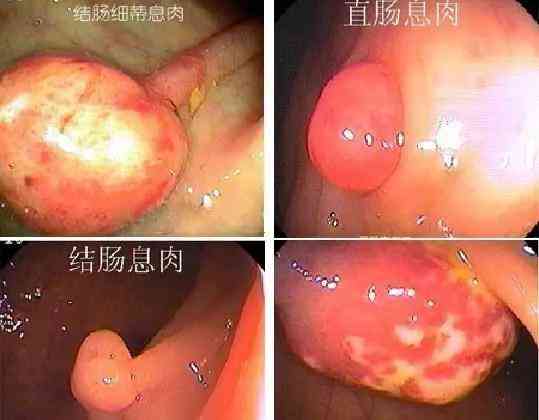 结直肠癌的元凶—大肠腺瘤