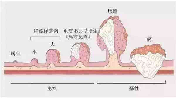 结直肠癌的元凶—大肠腺瘤
